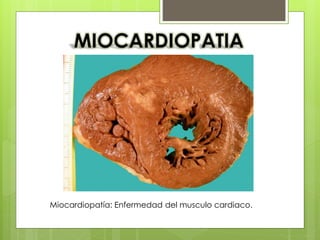 Miocardiopatía: Enfermedad del musculo cardiaco. 
 