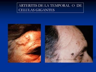 ARTERITIS DE LA TEMPORAL O DE
CELULAS GIGANTES
 
