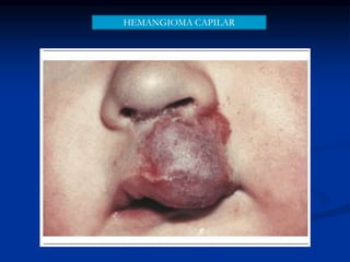 HEMANGIOMA CAPILAR
 