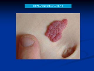 HEMANGIOMA CAPILAR
 