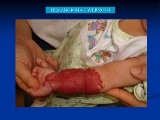HEMANGIOMA CAVERNOSO
 