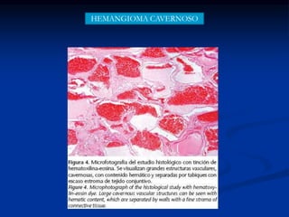 HEMANGIOMA CAVERNOSO
 