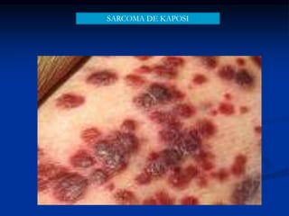 SARCOMA DE KAPOSI
 