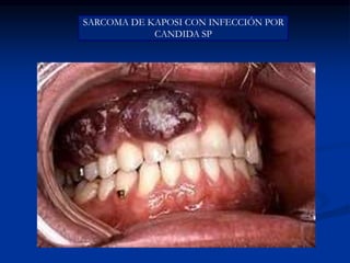SARCOMA DE KAPOSI CON INFECCIÓN POR
CANDIDA SP
 