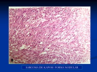 SARCOMA DE KAPOSI FORMA NODULAR
 