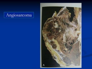 Angiosarcoma
 