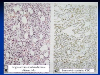 Angiosarcoma moderadamente
diferenciado Inmunohistoquimica CD31
 