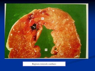 Ruptura músculo cardiaco
 