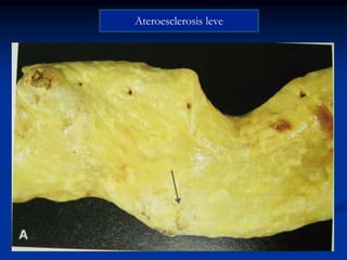 Ateroesclerosis leve
 