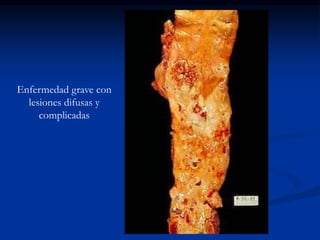 Enfermedad grave con
lesiones difusas y
complicadas
 