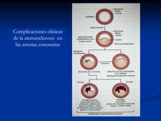 Complicaciones clínicas
de la ateroesclerosis en
las arterias coronarias
 