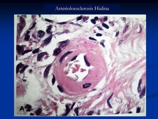 Arterioloesclerosis Hialina
 