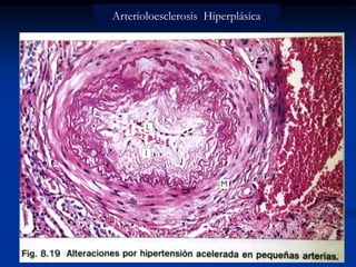 Arterioloesclerosis Hiperplásica
 