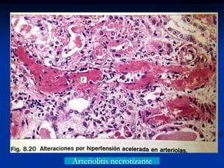 Arteriolitis necrotizante
 