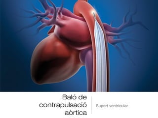 Baló de
contrapulsació
aòrtica
Suport ventricular
 