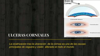 La cicatrización tras la ulceración de la córnea es una de las causas
principales de ceguera y visión alterada en todo el mundo
ULCERAS CORNEALES
 