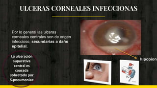 ULCERAS CORNEALES INFECCIONAS
Por lo general las ulceras
corneales centrales son de origen
infeccioso, secundarias a daño
epitelial.
Hipopion.
La ulceración
supurativa
central es
causada
sobretodo por
S.pneumoniae
 