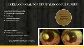 ULCERA CORNEAL POR STAPHYLOCOCCUS AUREUS
CARACTERÍSTICAS DE LA LESIÓN
◈ Ulcera central y superficial.
◈ Indoloras
◈ Hipopion, frecuente
◈ Infiltracion corneal
FACTORES DE RIESGO
◈ Uso topico de corticoides.
◈ Uso cronico de corticoides topicos
↓
QUERATOPATIA CRISTALINA INFECCIOSA
Tratamiento con:
• Cefazolina
• Moxifloxacina
• Gatifloxacina
 