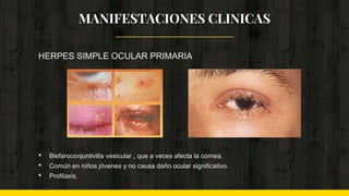 MANIFESTACIONES CLINICAS
HERPES SIMPLE OCULAR PRIMARIA
• Blefaroconjuntivitis vesicular , que a veces afecta la cornea.
• Común en niños jóvenes y no causa daño ocular significativo.
• Profilaxis.
 