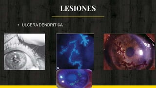 LESIONES
◈ ULCERA DENDRITICA
 