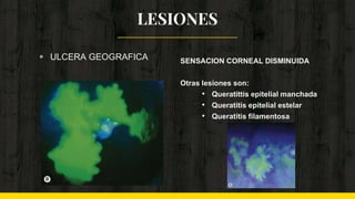 LESIONES
◈ ULCERA GEOGRAFICA SENSACION CORNEAL DISMINUIDA
Otras lesiones son:
• Queratittis epitelial manchada
• Queratitis epitelial estelar
• Queratitis filamentosa
 