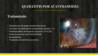 Tratamiento
Desbridacion del epitelio (etapas tempranas)
Uso tópico de isetionato de propanamida (solución 1%)
Polihexametileno de biguanida (solución 0.1%-0.2%)
Gotas oculares de neomicina fortificada
Queratoplastia
Trasplantes de membrana amniótica
QUERATITIS POR ACANTHAMOEBA
 