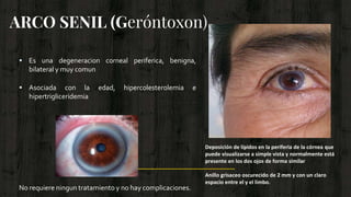 ARCO SENIL (Geróntoxon)
 Es una degeneracion corneal periferica, benigna,
bilateral y muy comun
 Asociada con la edad, h...
