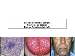 Lesão linfoepitelial Benigna
Síndrome de Sjögren
Doença Relacionada à IgG4
 