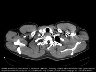 Comprehensive Overview of Aortic Pathology and Aneurysms: Diagnosis and ...