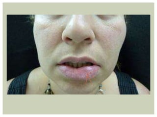 Patologia de labios | PPTX