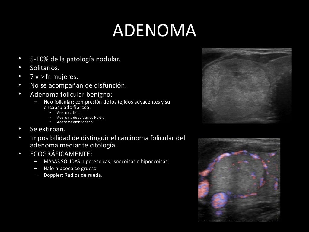 Differenza Tra Ecografia Tiroidea E Ecocolordoppler Tiroideo Patología de la glándula tiroidea en ecografia