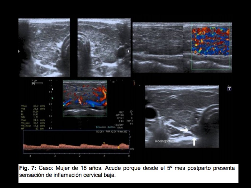 Differenza Tra Ecografia Tiroidea E Ecocolordoppler Tiroideo Patología de la glándula tiroidea en ecografia