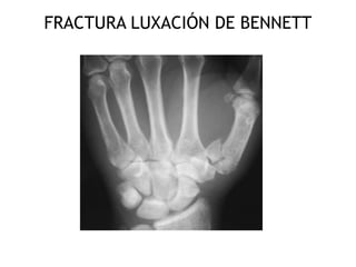 FRACTURA LUXACIÓN DE BENNETT 
 