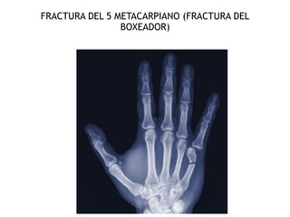 FRACTURA DEL 5 METACARPIANO (FRACTURA DEL
BOXEADOR) 
 
