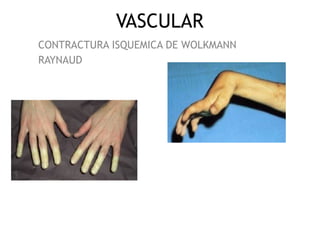 VASCULAR
CONTRACTURA ISQUEMICA DE WOLKMANN
RAYNAUD
 