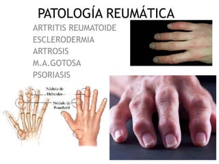 PATOLOGÍA REUMÁTICA
ARTRITIS REUMATOIDE
ESCLERODERMIA
ARTROSIS
M.A.GOTOSA
PSORIASIS
 