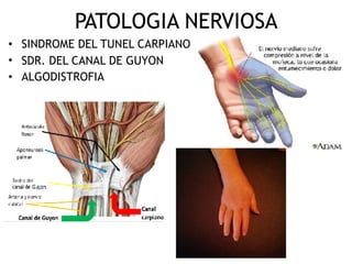 PATOLOGIA NERVIOSA
• SINDROME DEL TUNEL CARPIANO
• SDR. DEL CANAL DE GUYON
• ALGODISTROFIA
 