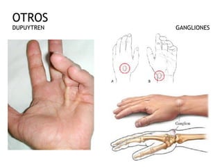 OTROS 
DUPUYTREN GANGLIONES
 