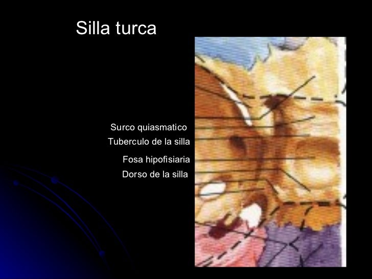 silla turca patologia de la silla turca silla turca patologia de la silla turca