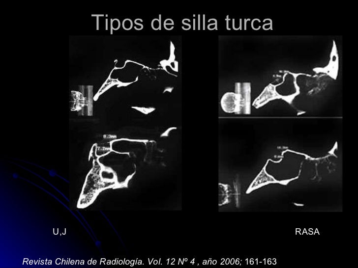 silla turca patologia de la silla turca silla turca patologia de la silla turca