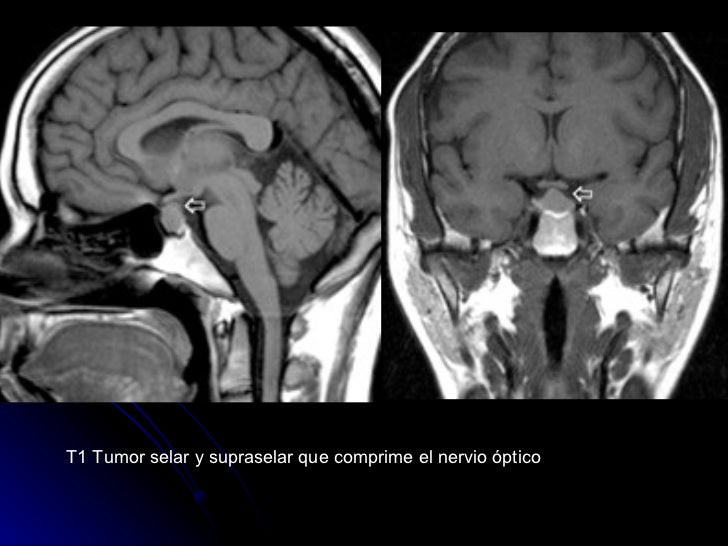 tumor silla turca patologia de la silla turca tumor silla turca patologia de la silla turca