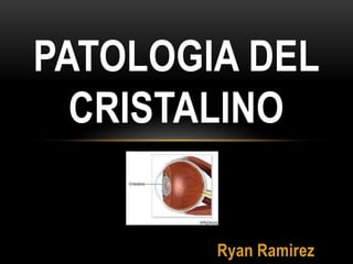 PATOLOGIA DEL
  CRISTALINO


        Ryan Ramirez
 