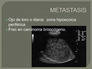  Ojo  de toro o diana: zona hipoecoica
  periférica
 Frec en carcinoma broncógeno.
 