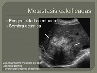  Ecogenicidadacentuada
   Sombra acústica




Adenocarcinoma mucinoso de colon
Adenoca gástrico
Tumores pancreáticos endocrinos
 