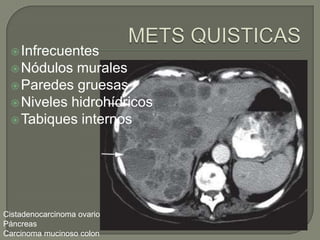  Infrecuentes
  Nódulos  murales
  Paredes gruesas
  Niveles hidrohídricos
  Tabiques internos




Cistadenocarcinoma ovario
Páncreas
Carcinoma mucinoso colon
 