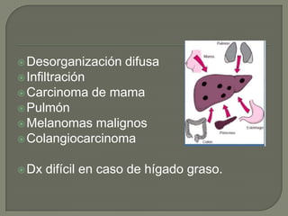  Desorganización    difusa
 Infiltración
 Carcinoma      de mama
 Pulmón
 Melanomas  malignos
 Colangiocarcinoma


 Dx   difícil en caso de hígado graso.
 