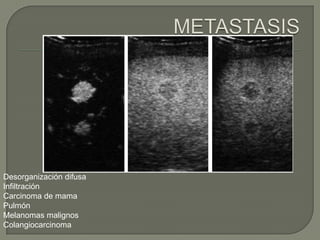 Desorganización difusa
Infiltración
Carcinoma de mama
Pulmón
Melanomas malignos
Colangiocarcinoma
 