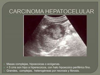    Masas complejas, hipoecoicas o ecógenas.
   < 5 cms son hipo a hiperecoicos, con halo hipoecoico periférico fino.
   Grandes, complejas, heterogéneas por necrosis y fibrosis.
 
