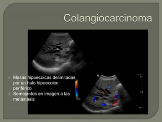    Masas hipoecoicas delimitadas
    por un halo hipoecoico
    periférico
   Semejantes en imagen a las
    metástasis
 