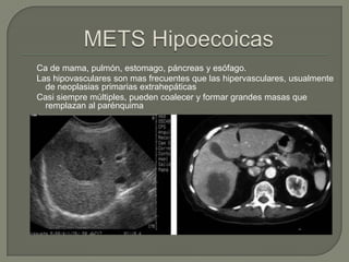 Ca de mama, pulmón, estomago, páncreas y esófago.
Las hipovasculares son mas frecuentes que las hipervasculares, usualmente
  de neoplasias primarias extrahepáticas
Casi siempre múltiples, pueden coalecer y formar grandes masas que
  remplazan al parénquima
 